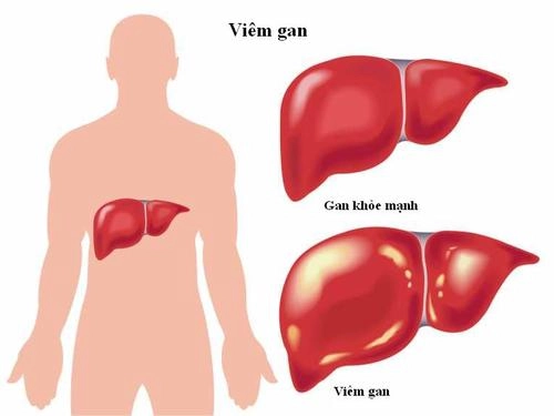  viêm gan virus dễ dẫn đến xơ gan ung thư gan - 1