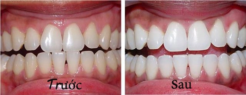 1 nhúm muối và 2 cách làm răng trắng bóng không ê buốt - 7