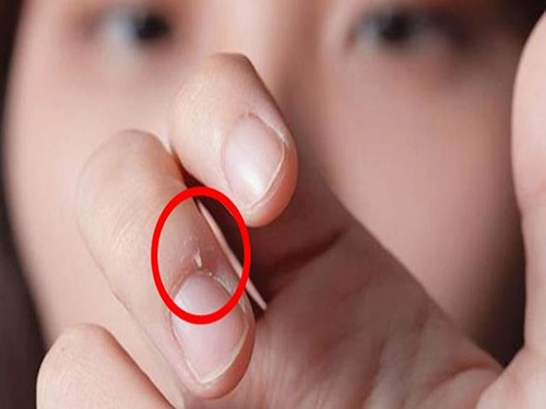Bé gái 7 tuổi phải nhập viện vì thói quen cắn xước măng-rô ngón tay - 1
