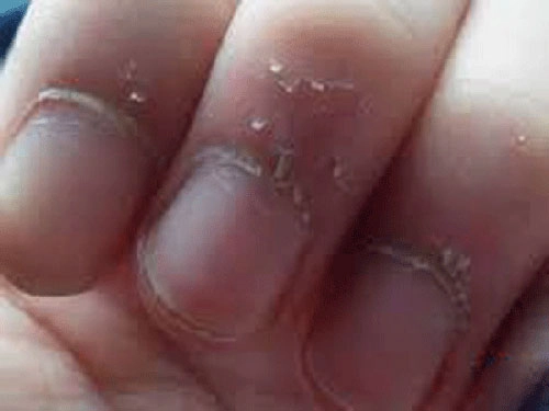 Bé gái 7 tuổi phải nhập viện vì thói quen cắn xước măng-rô ngón tay - 2