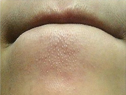 Bí kíp diệt tận gốc mụn đầu đen ở cằm và 2 cánh mũi - 1