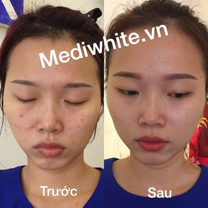 Bí quyết vàng xóa tan thâm mụn với medi white - 4