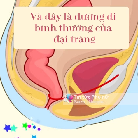 Chỉ vì chiếc bồn cầu con có nguy cơ bị ung thư đại tràng - 9