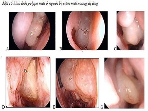 Chuyên gia tai mũi họng cảnh báo những bệnh nguy hiểm xuất hiện lúc giao mùa - 1