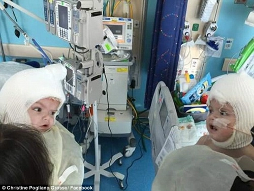 Hai bé trai song sinh liền đầu lần đầu được nhìn thấy nhau sau phẫu thuật - 1