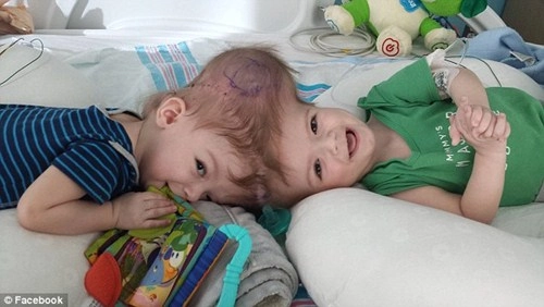 Hai bé trai song sinh liền đầu lần đầu được nhìn thấy nhau sau phẫu thuật - 2