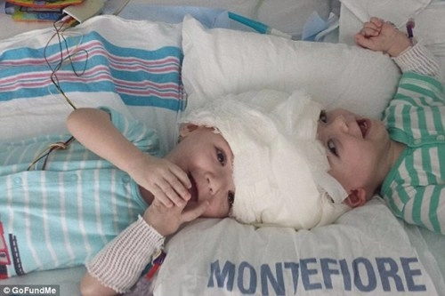 Hai bé trai song sinh liền đầu lần đầu được nhìn thấy nhau sau phẫu thuật - 6