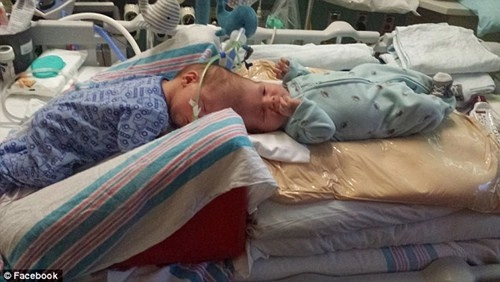 Hai bé trai song sinh liền đầu lần đầu được nhìn thấy nhau sau phẫu thuật - 7