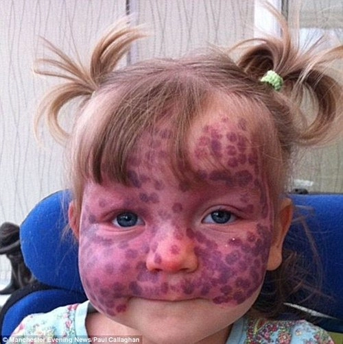 Khuôn mặt khác lạ sau phẫu thuật của bé gái bị chàm trên mặt - 1