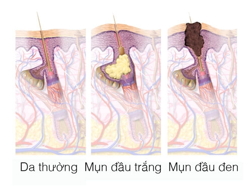 Mụn đầu đen sợi bã nhờn cách phân biệt xử lý ngăn chặn - 5