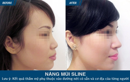 Nâng mũi sụn tự thân tính lợi tính hại thế nào - 4