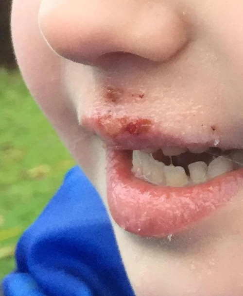 Người mẹ không ngờ vật dụng quen thuộc này khiến con 6 tuổi bị bỏng rộp chảy máu môi - 1