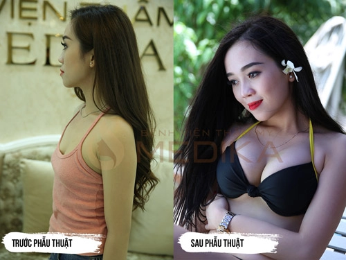 Nguyên nhân và cách khắc phục rãnh ngực rộng khi nâng ngực nội soi - 3