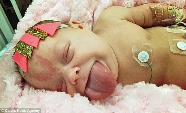 Nụ cười ngọt lịm của bé sơ sinh từng không thể ăn vì lưỡi to cứ cắt lại mọc - 1