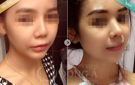 Trào lưu thẩm mỹ mũi hàn quốc 5s gold thu hút giới trẻ - 3