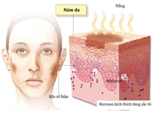  chiêu giúp các nàng công sở đẩy lùi nám da - 2