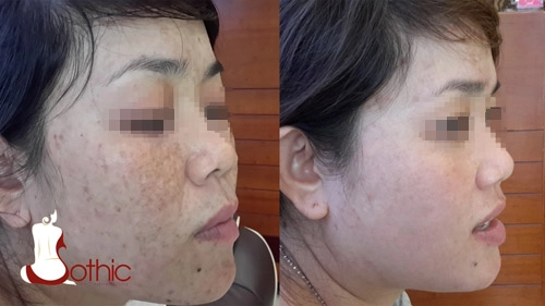 Cung cấp vi chất đẩy lùi nám nhanh bằng giải pháp mesotherapy - 1