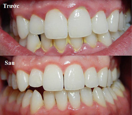 4 cách làm trắng răng hiệu quả an toàn áp dụng ngay tại nhà - 8