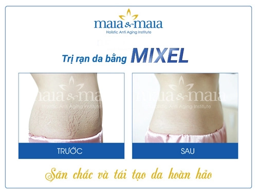 Thoát khỏi ám ảnh rạn da sau sinh với những tuyệt chiêu này - 5