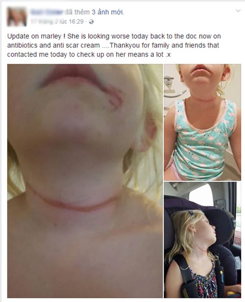 Chỉ vì chiếc dây quai mũ bé gái 6 tuổi bị siết cổ gần nghẹt thở - 2