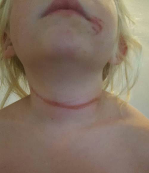 Chỉ vì chiếc dây quai mũ bé gái 6 tuổi bị siết cổ gần nghẹt thở - 4