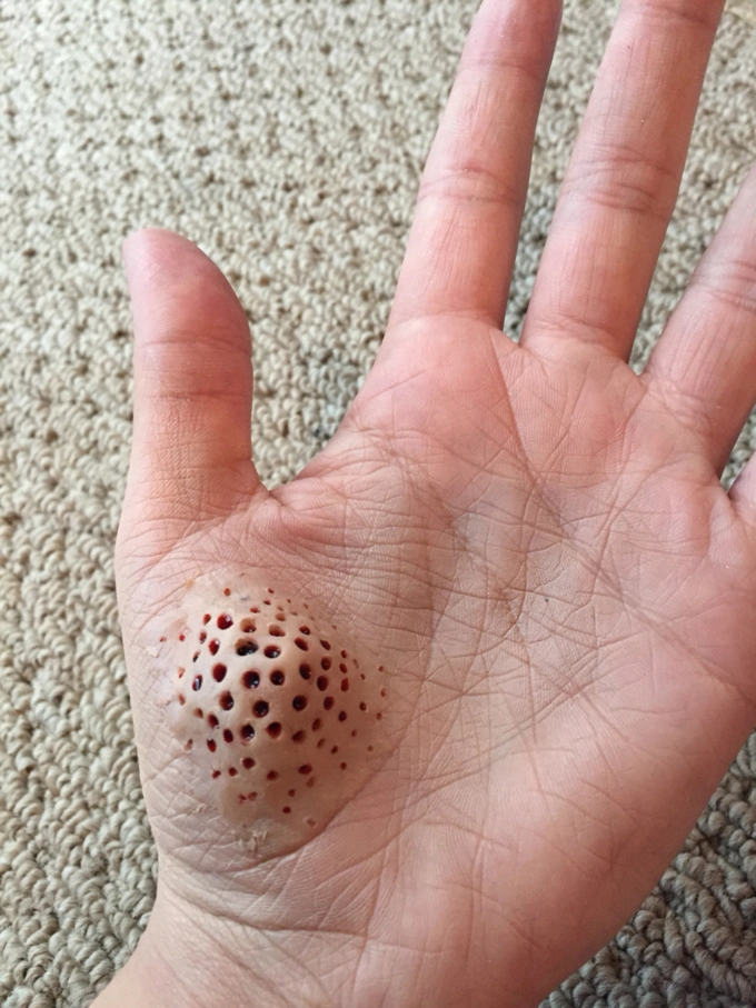 Bạn biết gì về hội chứng sợ lỗ - trypophobia - 9