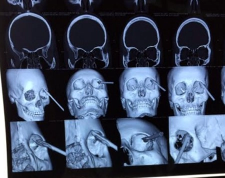 Cứu sống bệnh nhân bị đoạn sắt đâm xuyên mắt - 1