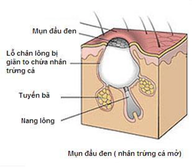 Đi tìm phương pháp trị mụn đầu đen hiệu quả nhất mà không làm tổn hại làn da - 1