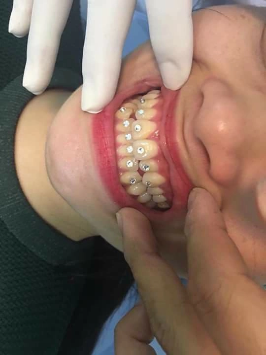 Ham làm đẹp cô gái gắn 12 viên đá vào răng rồi khổ sở tìm tới nha sĩ - 1
