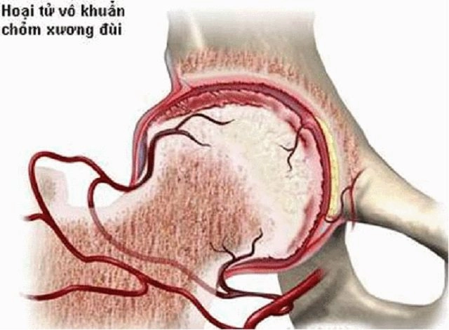 Hoại tử chỏm xương đùi căn bênh đang tre hoa va găp 80 ơ nam giơi - 1