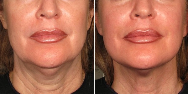 Làm đẹp với ultherapy cần thận trọng chọn mặt gửi vàng - 1