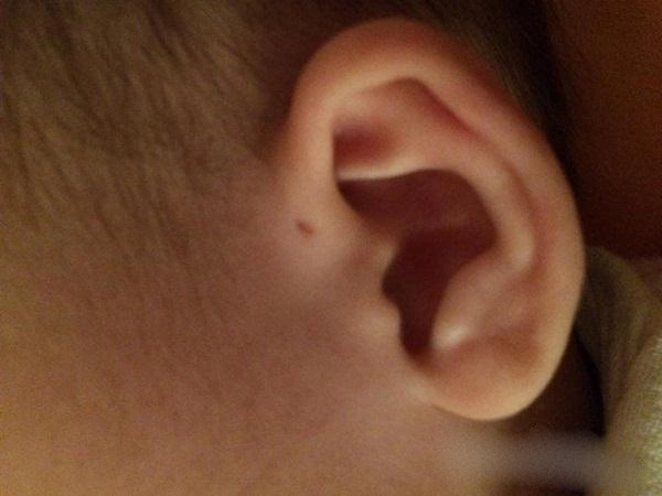 Mẹ cứ ngỡ con có lỗ nhỏ ở vành tai là thông minh nhưng sự thật lại rất nguy hiểm - 1