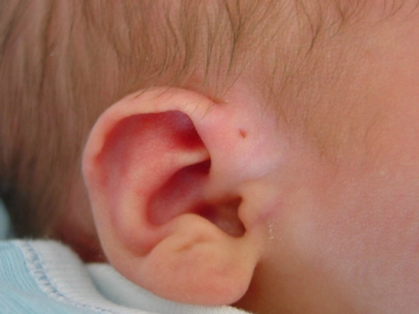Mẹ cứ ngỡ con có lỗ nhỏ ở vành tai là thông minh nhưng sự thật lại rất nguy hiểm - 2