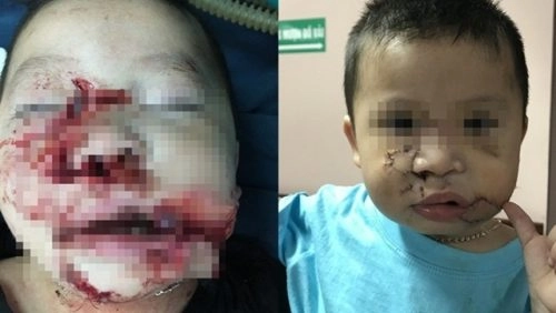Phẫu thuật tạo hình thanh công cho bé trai 2 tuổi bị chó cắn nát mặt - 1