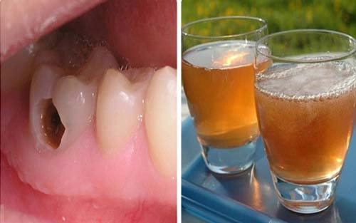 Chữa đau răng chưa bao giờ dễ thế với 4 nguyên liệu có sẵn trong bếp - 9
