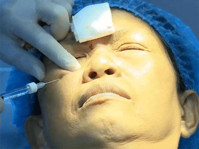 Làm đẹp bằng phương pháp tiêm filler cẩn thận tiền mất tật mang khi ham giá rẻ - 6