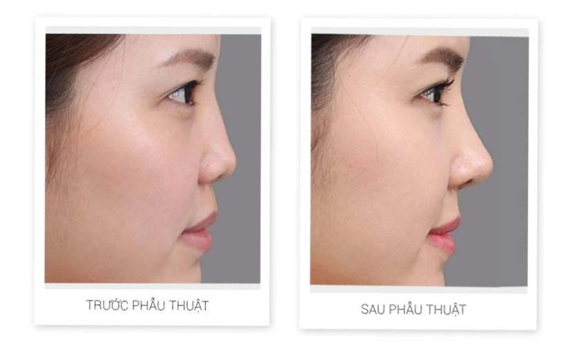 Nâng mũi bị tím mắt nguyên nhân vì đâu - 1
