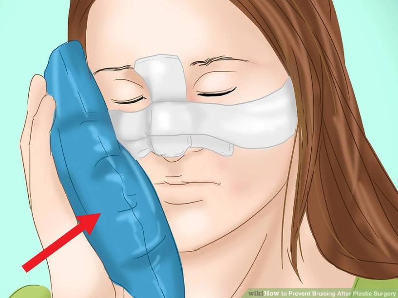 Nâng mũi bị tím mắt nguyên nhân vì đâu - 3