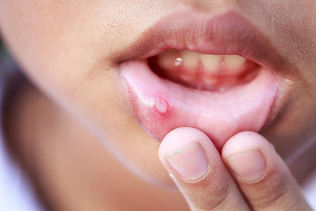 Những triệu chứng dễ nhầm lẫn về bệnh ung thư miệng thường gặp - 1