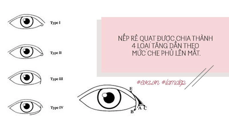 Thích mắt to nhờ cắt mí chưa đủ chị em còn muốn mắt dài nhờ phẫu thuật mở tròng mắt - 4