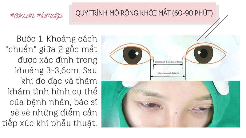 Thích mắt to nhờ cắt mí chưa đủ chị em còn muốn mắt dài nhờ phẫu thuật mở tròng mắt - 5