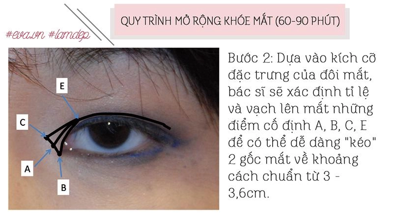 Thích mắt to nhờ cắt mí chưa đủ chị em còn muốn mắt dài nhờ phẫu thuật mở tròng mắt - 6