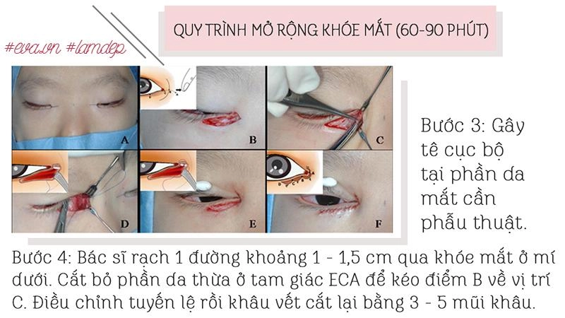 Thích mắt to nhờ cắt mí chưa đủ chị em còn muốn mắt dài nhờ phẫu thuật mở tròng mắt - 7