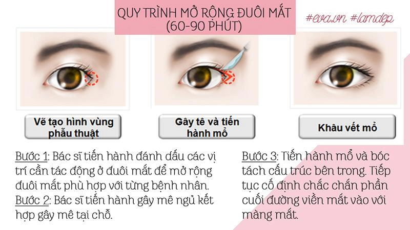 Thích mắt to nhờ cắt mí chưa đủ chị em còn muốn mắt dài nhờ phẫu thuật mở tròng mắt - 12