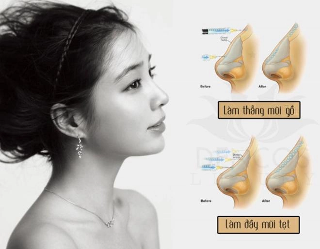 Chị em phát sốt vì mũi cao cằm v-line mà không cần dao kéo không gây đau đớn - 2