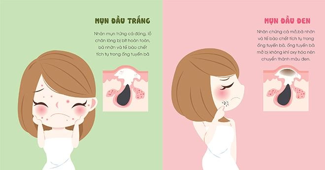 Khi bị mụn trứng cá sưng vù hành hạ quy trình dưỡng da có khác gì hằng ngày - 3