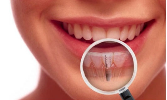 Những yếu tố nào ảnh hưởng đến kết quả trồng răng implant - 1