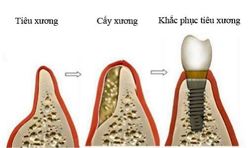 Những yếu tố nào ảnh hưởng đến kết quả trồng răng implant - 2