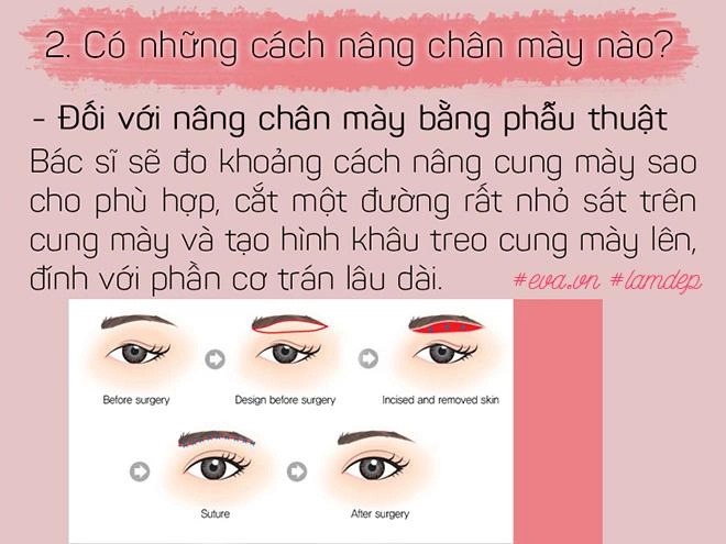 Bỏ 20 triệu chữa sụp mí bằng nâng cung chân mày chị em nhận được gì - 4