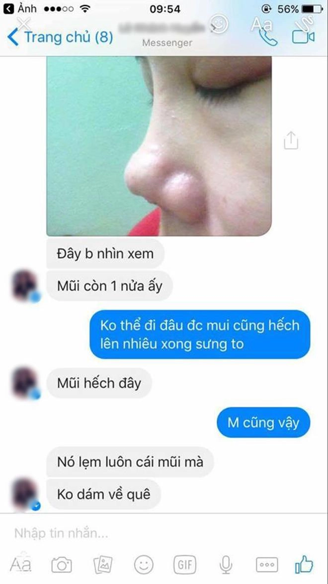 Bỏ 25 triệu làm mũi và bị hỏng cô gái phải chịu 9 lần khâu lại không thuốc tê - 7